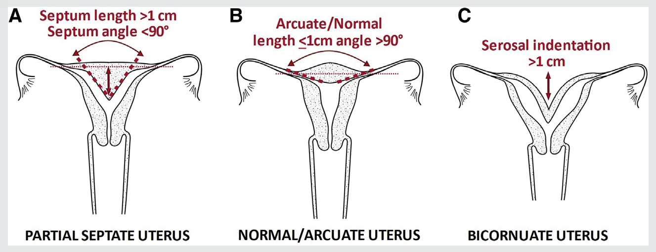 fig10-asrm-mullerian-anomalies.webp