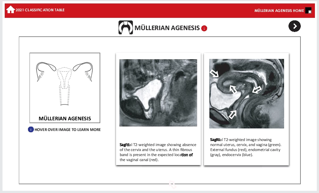 fig9-asrm-mullerian-anomalies.webp