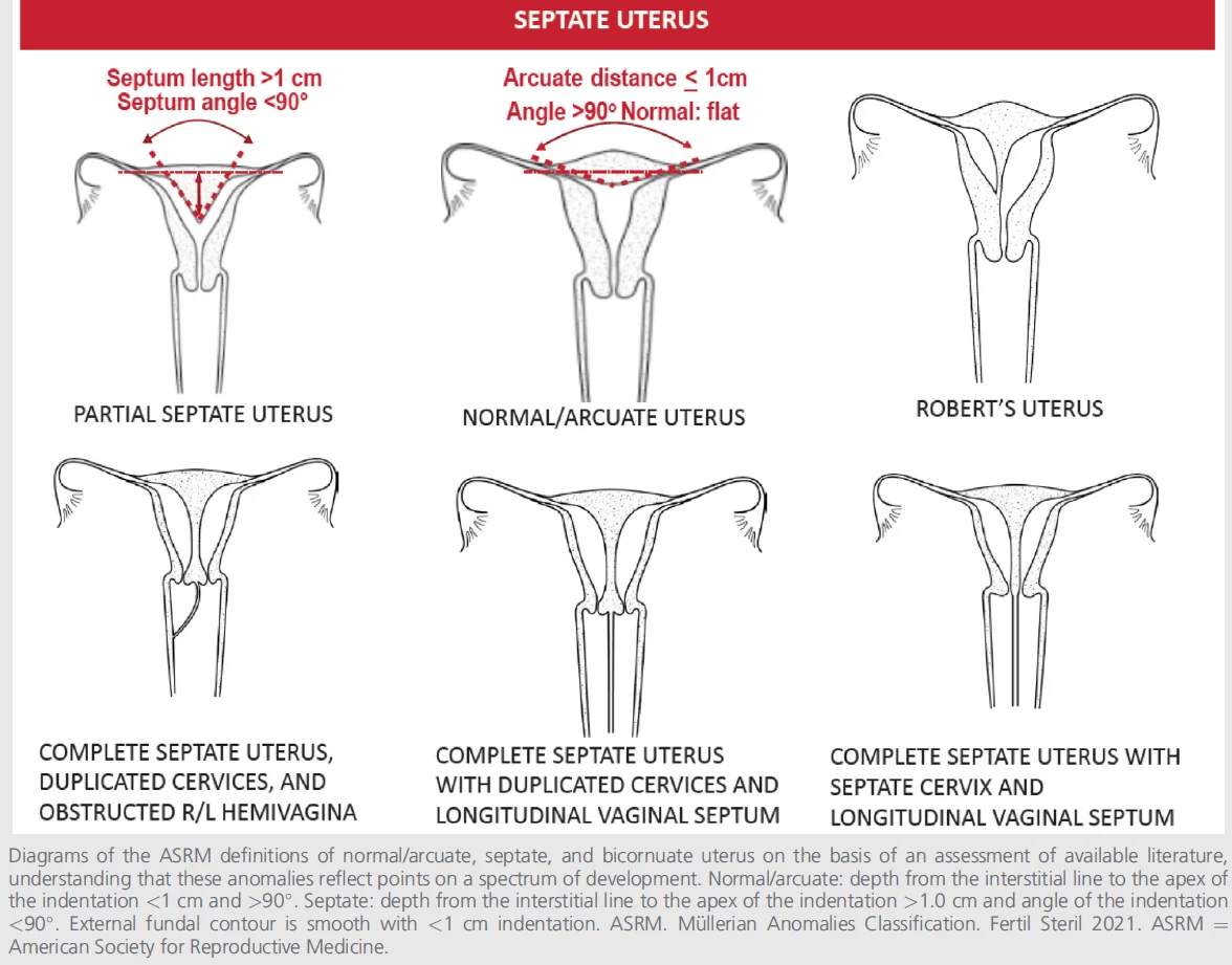 Evidence-based diagnosis and treatment for uterine septum: a guideline ...